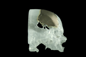 KWINTESSENS Porous titanium cranial plate designed in 3-matic_3D model of sull with cranial defect created in Mimics_Copyright OBL_www.biomedical.materialise.com